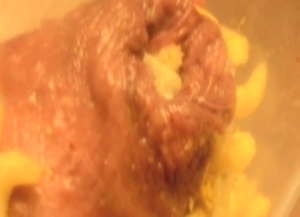 Maggots now live comfortably in his foreskin